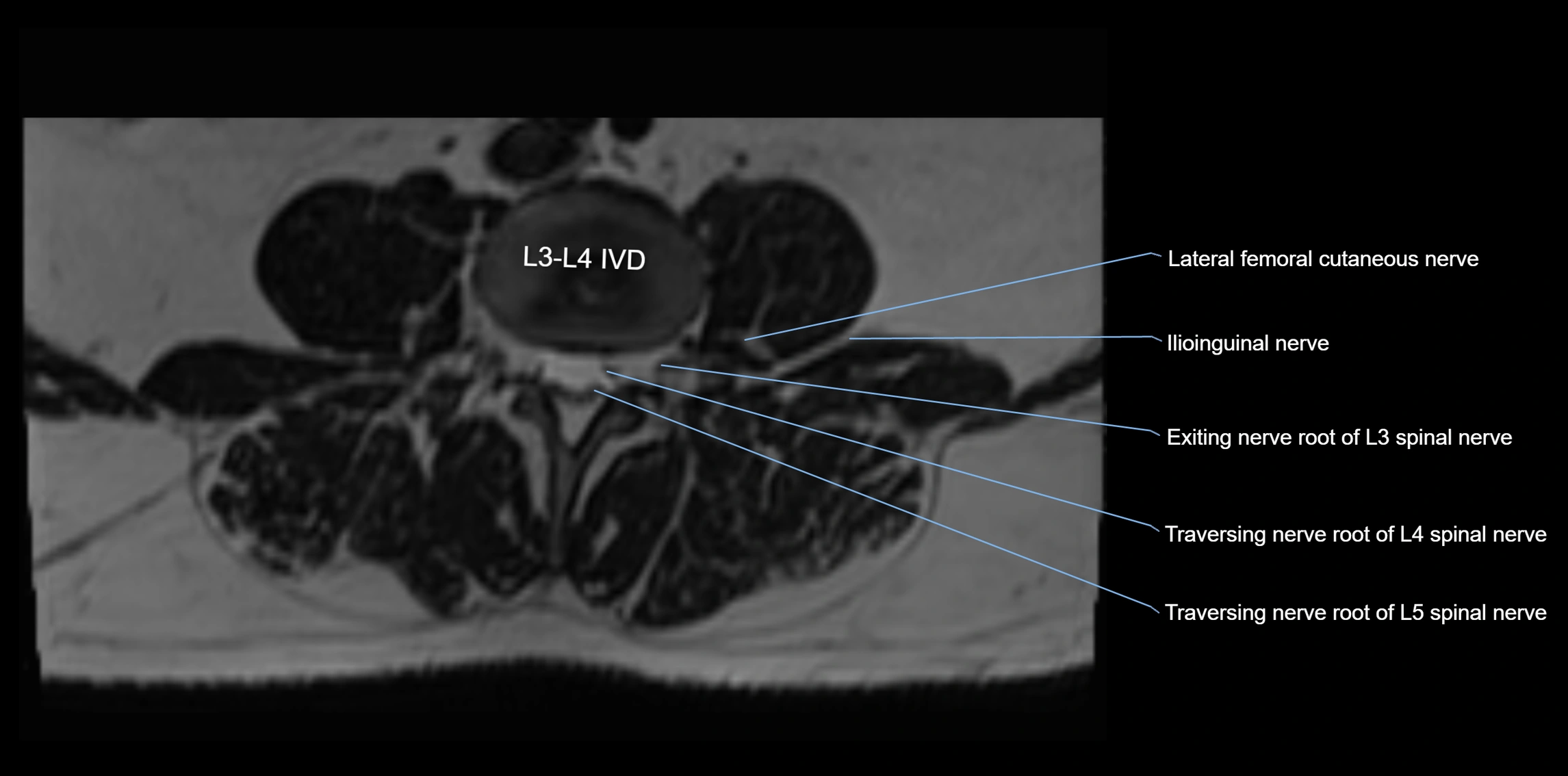 MR lumbosacral plexus axial cross sectional anatomy 3T  radiology  image-img-1008001-00027.webp